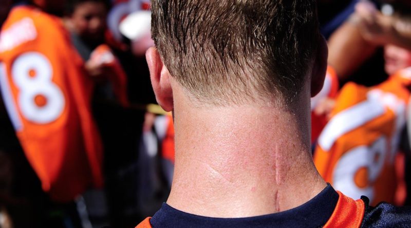 I segni sul collo di Peyton Manning dopo le quattro operazioni